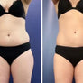 Formnovélle Body Contouring