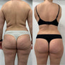 Formnovélle Body Contouring