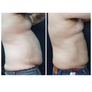 Formnovélle Body Contouring